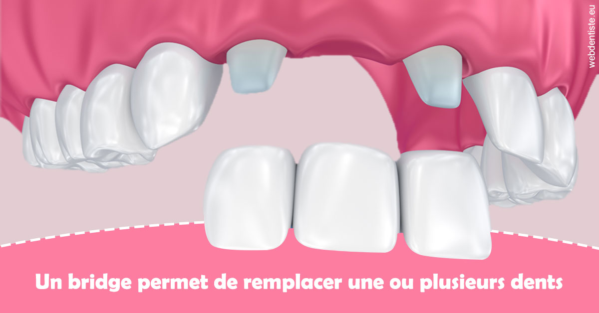 https://selarl-michelsolt.chirurgiens-dentistes.fr/Bridge remplacer dents 2
