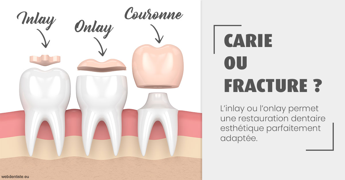 https://selarl-michelsolt.chirurgiens-dentistes.fr/T2 2023 - Carie ou fracture 1