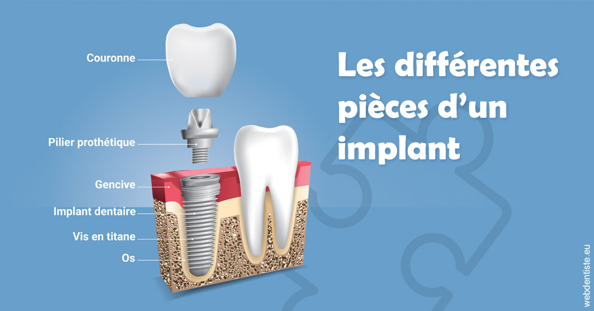 https://selarl-michelsolt.chirurgiens-dentistes.fr/Les différentes pièces d’un implant 1